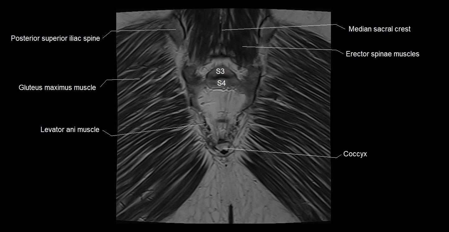 MRI coronal cross sectional anatomy male pelvis image 39.webp